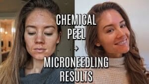 How Long After Microneedling Can I Get a Chemical Peel?