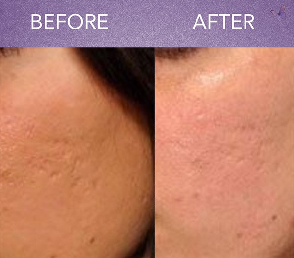 How Many Microneedling Sessions for Acne Scars?