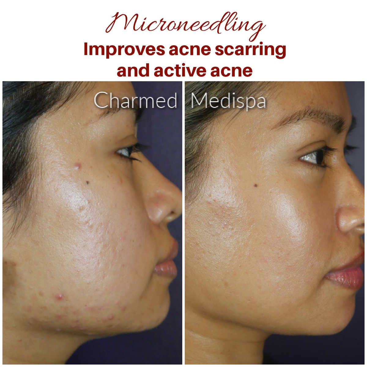 How to Treat Breakouts After Microneedling?