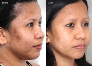 How to Treat Hyperpigmentation After Microneedling?