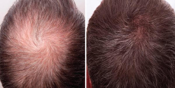 What is Microneedling for Hair Loss?