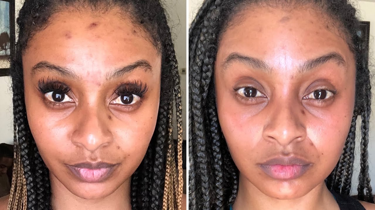 Why is My Skin Darker After Microneedling?